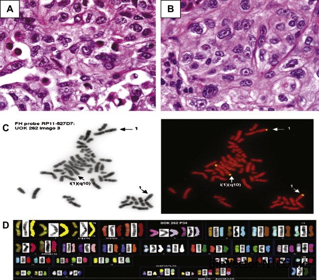 UOK 262 cell line, fumarate hydratase deficient (FH?/FH?) hereditary  leiomyomatosis renal cell carcinoma:in vitro and in vivo model of an  aberrant energy metabolic pathway in human cancer - ScienceDirect